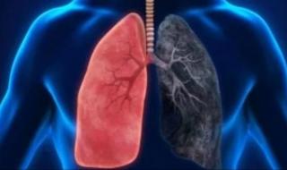 شهر التوعية بسرطان الرئة.. خطوات بسيطة تحافظ على صحة رئتيك