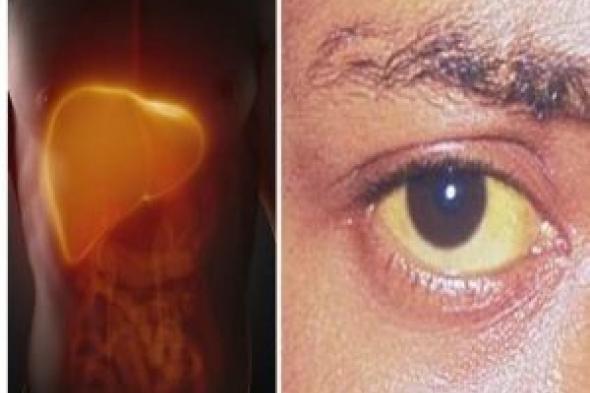 أخصائي يكشف سبب اصفرار بياض العين: أنت مصاب بمرض خطير وهذا هو العلاج